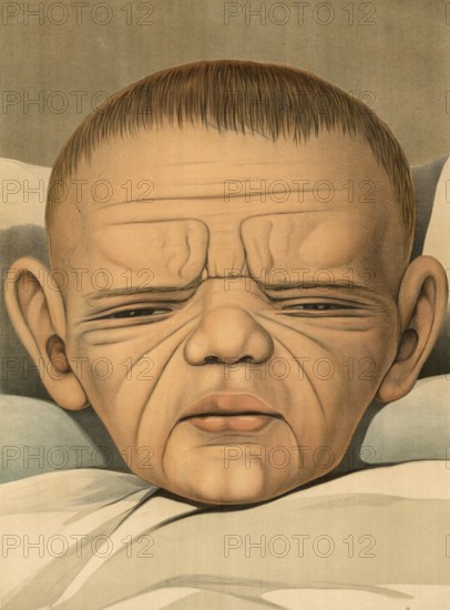 Medical illustration, clinical picture, venereal disease, syphilis, hereditary syphilis, child with