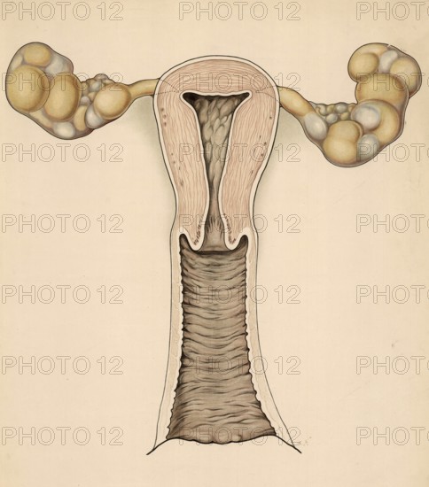Medical illustration, clinical picture, venereal disease, gonorrhea, female reproductive organs