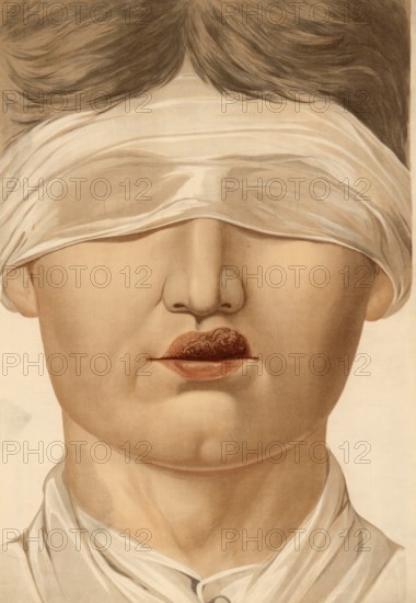 Medical illustration, clinical picture, venereal disease, primary affect of syphilis on the upper