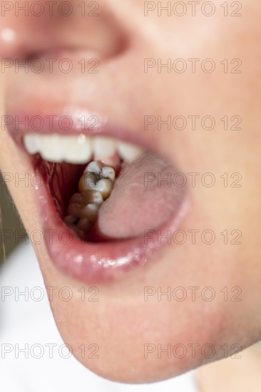 Woman with her mouth open shows a visible amalgam filling on her molar during a dental examination