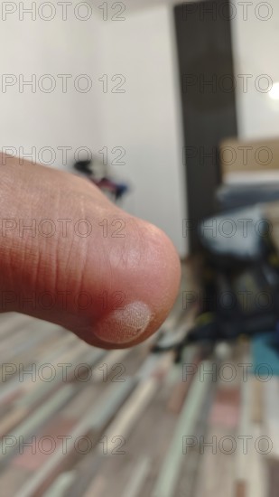 Close-up of a heel with a huge bladder from hiking with a backpack in the background, consequences