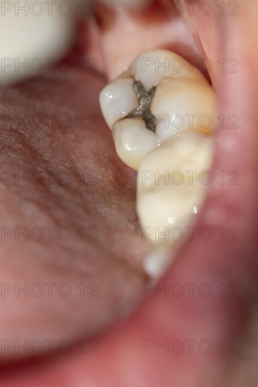 Woman with her mouth open shows a visible amalgam filling on her molar during a dental examination