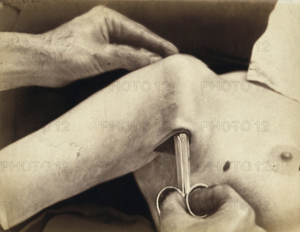 Patient, operation, a surgical instrument made of metal is inserted in an incision in the armpit,