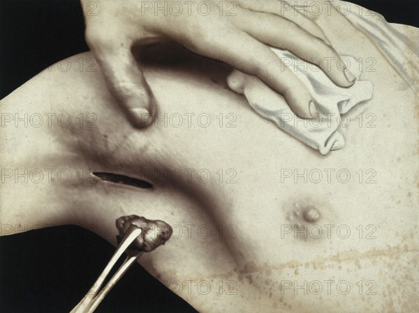 Patient, surgery, breast surgery, lump removal, tumor, metal surgical instrument inserted through
