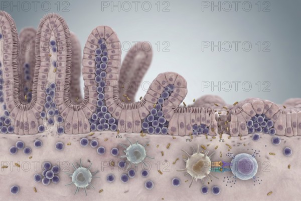 Microscopic cross-section of the small intestinal mucosa in coeliac disease: inflammatory cells
