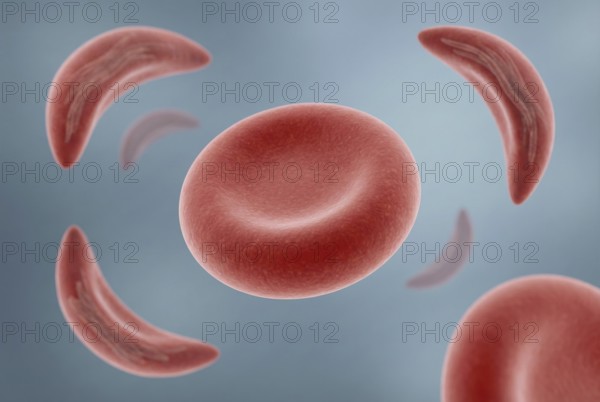 Visualization of CRISPR gene therapy for sickle cell anemia: An altered red blood cell that