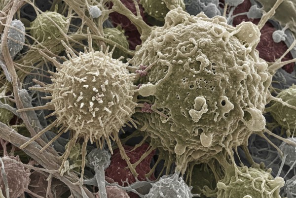Macro-visualization of a CAR-T immune cell that binds to a tumor cell with cell membranes and tumor