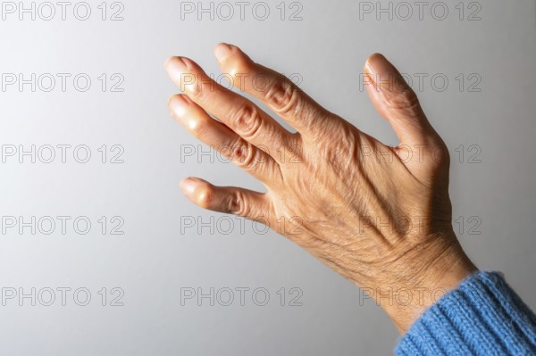 Close up of a senior woman's hand, revealing swollen joints and deformities caused by arthritis
