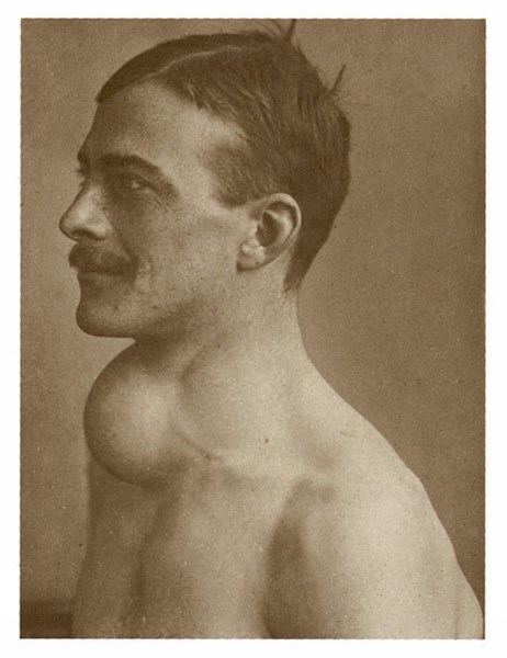 A man suffering from Grave's disease (exophtalmic goitre)
