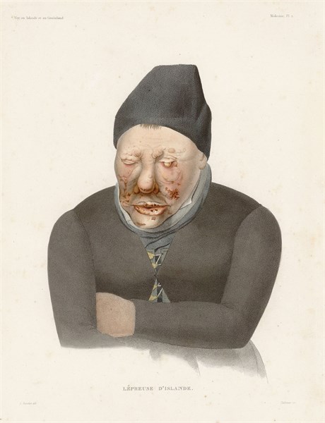 Malade de la lèpre, 1835