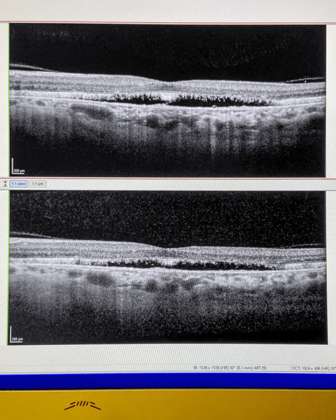 OCT scan (Optical Coherence Tomography) of human retina, both eyes