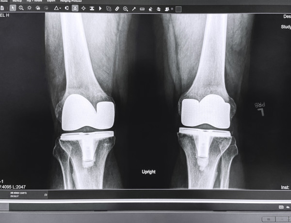 X-ray of adult man's knees after knee replacement surgery