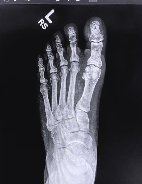X-ray of broken toe on left foot