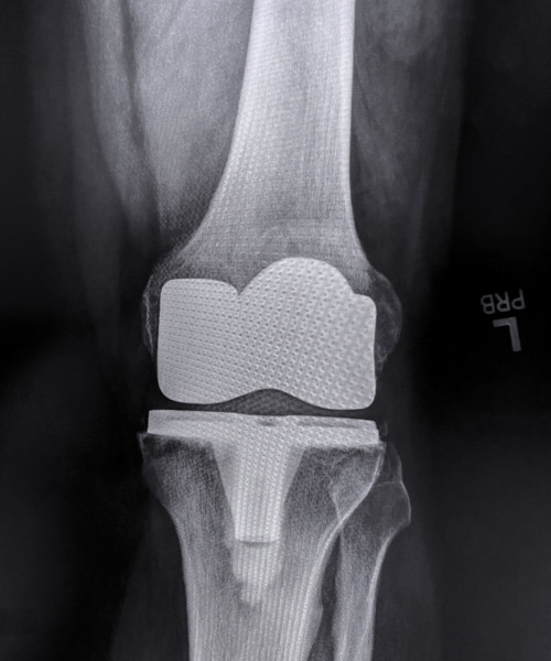 X-ray of adult man's left knee after knee replacement surgery