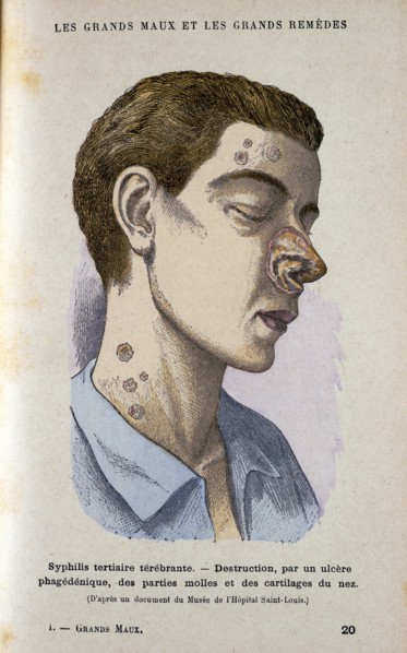 Symptoms of the tertiary phase of syphilis, c19th century. Artist: Unknown