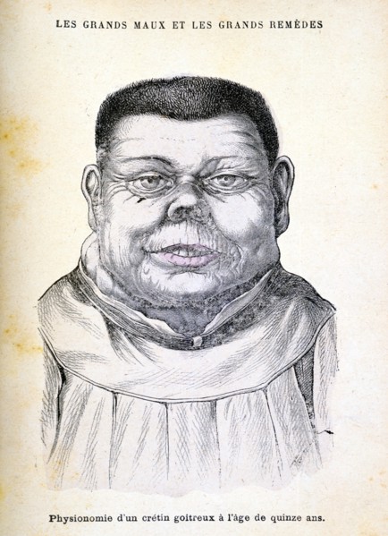 Cretin aged 15, c1890. Artist: Unknown