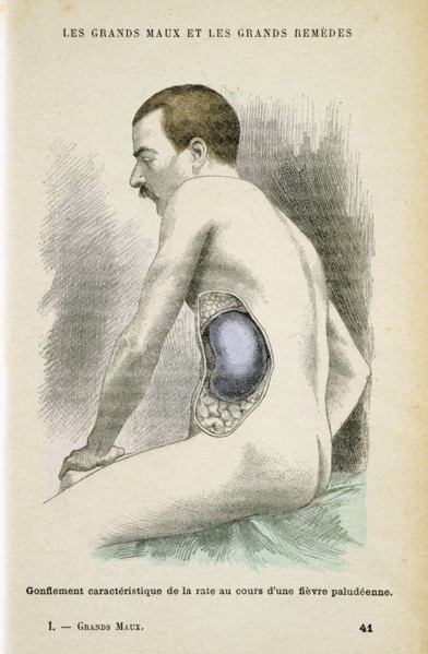 Typical enlarged spleen of a Malaria patient, c1890. Artist: Unknown