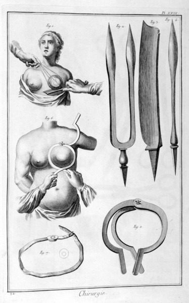 Breast surgery, 1751-1777. Artist: Unknown