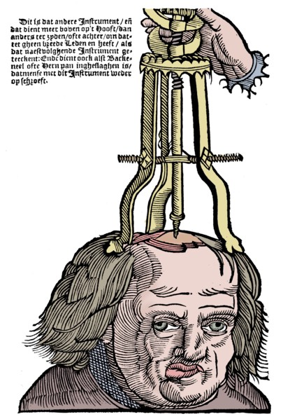 Trephination, 1593. Artist: Unknown.
