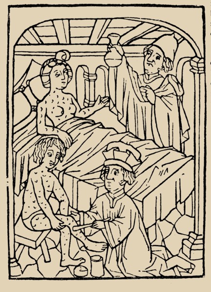 Syphilis treatment: Treatment with ointments (mercury). From: A Malafranczos morbo gallorum preserv
