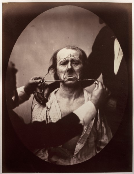 Figure 45: Contraction électrique forte des triangulaires des lèvres et des sourciliers:..., c. 1856 Creator: Guillaume-Benjamin-Amand Duchenne (de Boulogne) (French, 1806-1875); Adrien Tournachon (Fr...