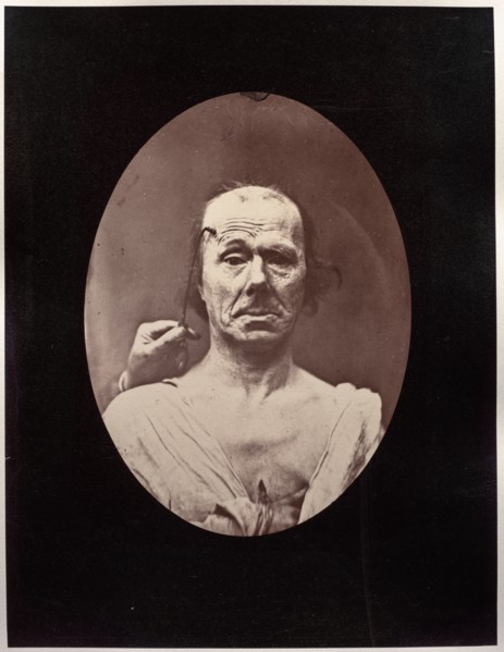 Figure 7: Étude du méchanisme et de lexpression du muscle frontal chez un vieillard: à droit..., c.  Creator: Guillaume-Benjamin-Amand Duchenne (de Boulogne) (French, 1806-1875); Adrien Tournachon (Fr...