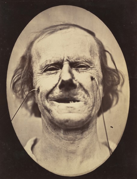 Figure 48: Mild weeping, pity and feeble false laughter , 1854-56, printed 1862.