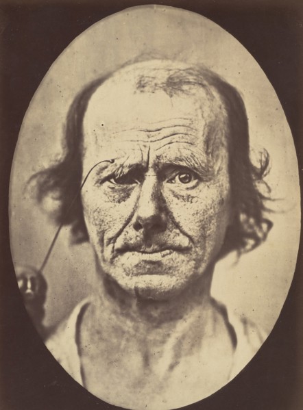 Figure 12: A study of the contraction of and the expression produced by the superior part of m. orbicularis oculi , 1854-56, printed 1862.