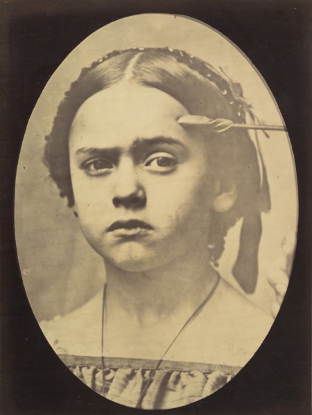 Figure 10: Showing the expressive lines of m. frontalis in a young girl , 1854-56, printed 1862.