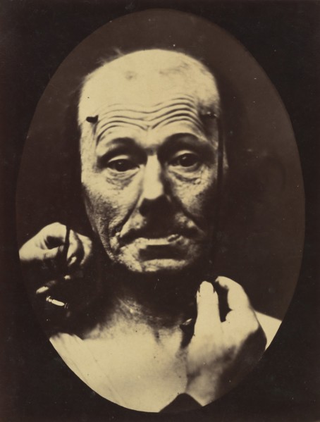 Figure 8: Contraction of the right m. frontalis. , 1854-56, printed 1862.