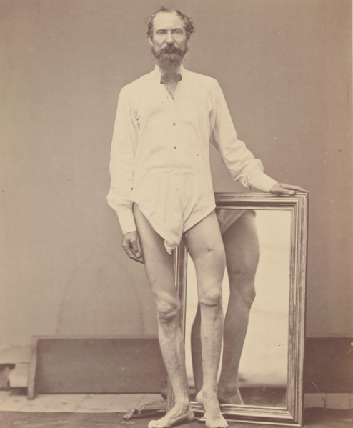 Gunshot Wound of Middle Third of Left Femur, 1865-67.