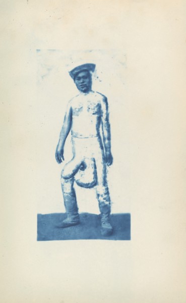 Elephantiasis, c. 1870s.