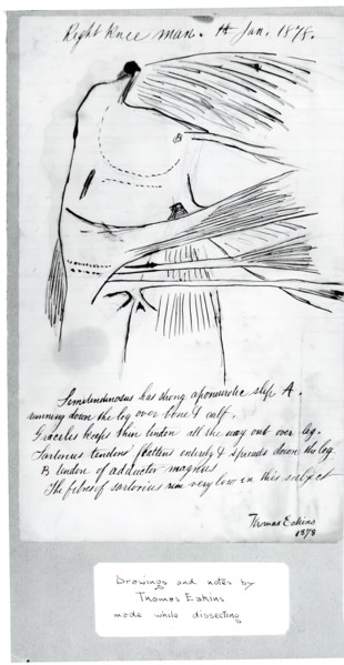 (Untitled) (Anatomical Study Of Right Knee), 1878.