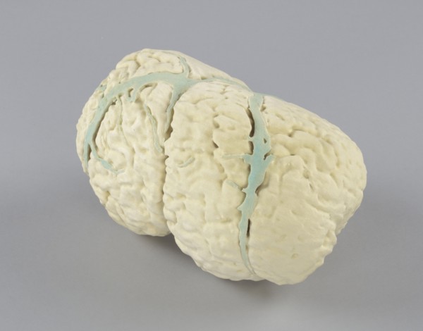 Model of the conjoined brains of Ladan and Laleh Bijani used by Dr. Ben Carson, 2003. Creator: Unknown.