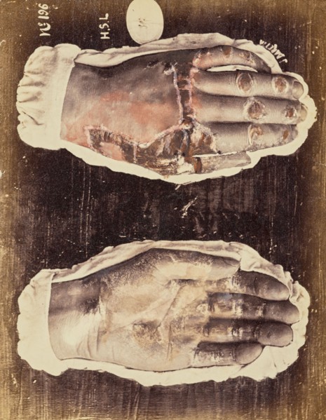 Psoriasis scarlatiniforme, 1871. Creator: Arthur de Montmeja.