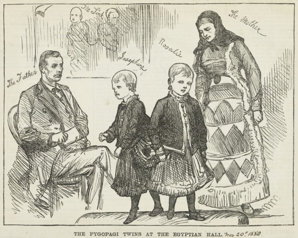 The Pyopagi Twins shown at Egyptian Hall, 1880. Pygopagi twins are conjoined at the buttocks.
