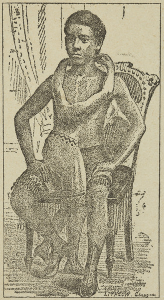 Lalloo, The Greatest Living Wonder on Earth, 1887. Illustration from an advertisement for the