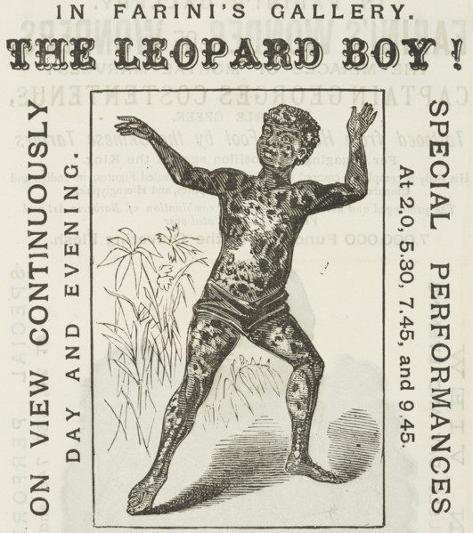 The Leopard Boy! in Farini's Gallery, 1881. 'On View Continuously, Day and Evening. Spotted black,