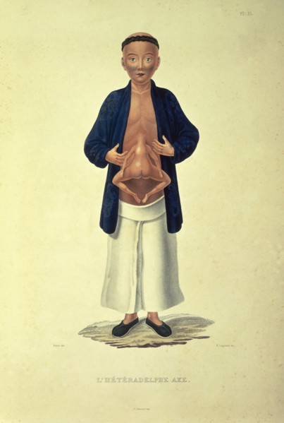 L'heteradelphe Ake, c1824-c1826. A human figure with a body growing from the stomach. The term