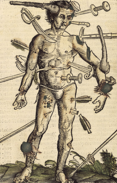 The wound man, 1517. German surgeon Hans von Gersdorff wrote a book with instructions for