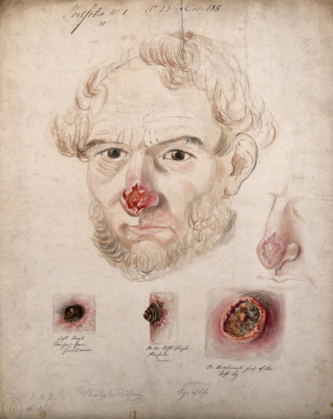 Head of a man with a severe disease affecting his nose; a detail of the nose..., 1800-1899. Creator: Christopher D'Alton.