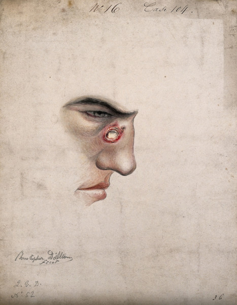 A detail of a man's face seen in profile with a severe disease affecting his nose, 1856. Creator: Christopher D'Alton.