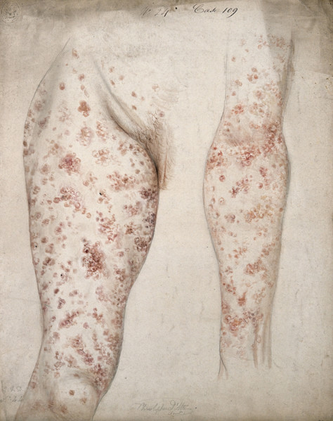 Sores and diseased skin on the leg and arm of a woman, 1856. Creator: Christopher D'Alton.