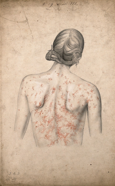 Back of a woman suffering from a rash of sores, 1855. Creator: Christopher D'Alton.