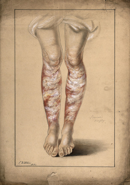 Diseased skin on the legs of a man suffering from psoriasis, 1873. Creator: Christopher D'Alton.