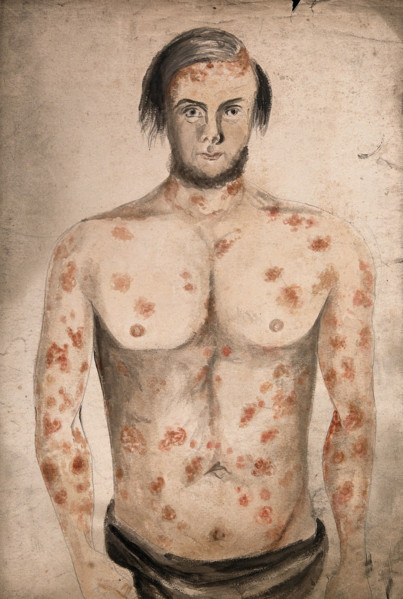 The face, arms and torso of a man suffering from diseased skin and abcesses (?), between 1800 & 1899 Creator: Christopher D'Alton.