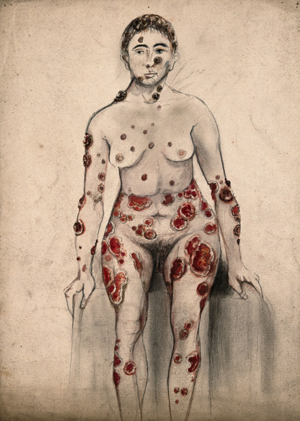 A woman suffering from open sores and abcesses on her face and entire body, 1867. Creator: Christopher D'Alton.