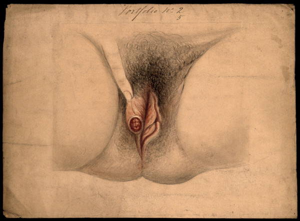 Female genitalia held open by a finger to show an area of diseased tissue, (18)66. Creator: Christopher D'Alton.