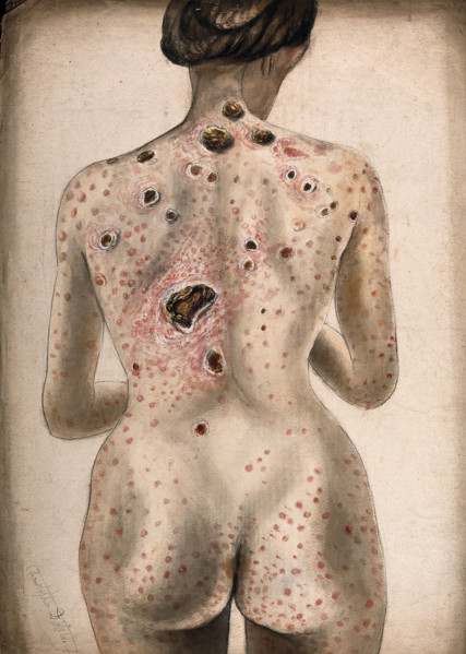 The back, buttocks and arms of a woman, displaying areas of diseased tissue..., (1840/1870?). Creator: Christopher D'Alton.
