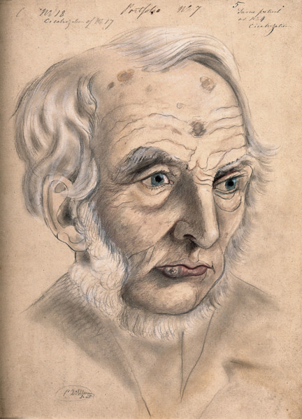 A man suffering from chancre of the lip, displaying scar tissue on his lower lip, forehead..., 1867. Creator: Christopher D'Alton.